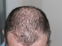 Tips for Hair loss, Baldness, Hair Regrowth