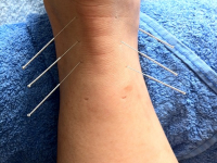 CLASES DE ACUPUNTURA 