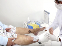 Abordagem e tratamentos de ostomia, feridas e queimaduras