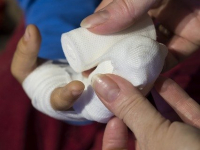 Assistência de Enfermagem ao Paciente Queimado