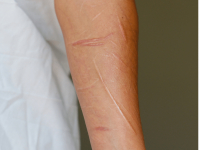 IDEAÇÃO , AUTOMULTILAÇÃO E COMPORTAMENTO SUÍCIDA