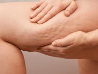 TECNICAS INJETAVEIS CARBOXITERAPIA