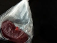 Bioquímica Clinica em Diabetes Renal