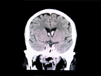 HIPERTENSÃO INTRACRANIANA: CONCEITOS E CONDUTAS