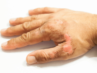 TECNOLOGIA DOS TRATAMENTOS E COBERTURAS ESPECIAIS DE CURATIVOS E DESBRIDAMENTO