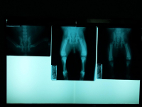 Movimento Pélvico- Avaliação, Disfunções E Tratamentos